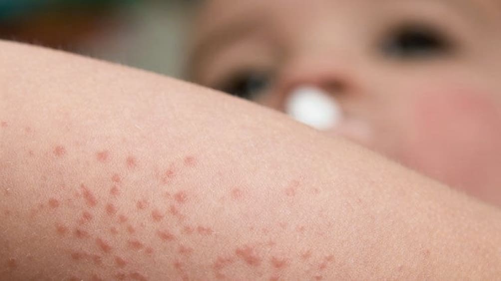 Dermatitis Atópica, un trastorno cutáneo que padecen entre un 15 y 30% de niños y niñas